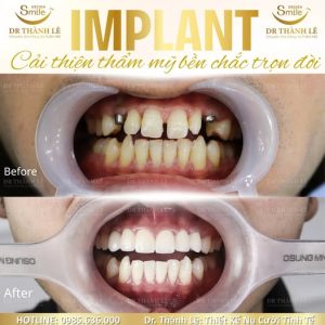 cấy implant