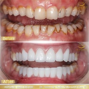 bọc răng sứ