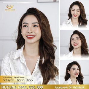 dán sứ veneer