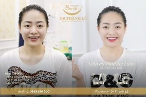 dán sứ veneer