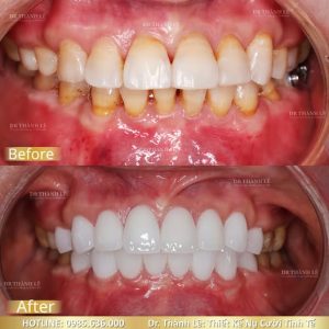 bọc sứ thẩm mỹ