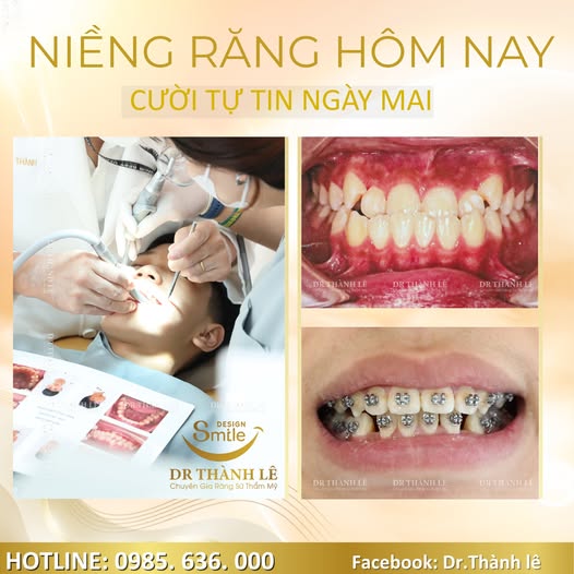 niềng răng hô