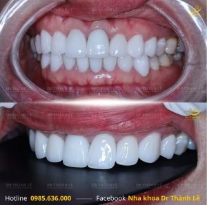 bọc răng sứ