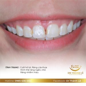 phẫu thuật cắt lợi