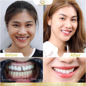bọc răng sứ
