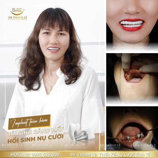 cấy implant