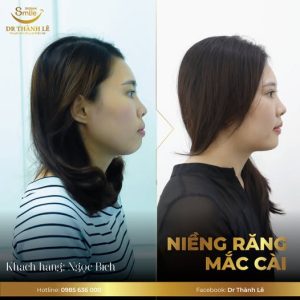 niềng răng 