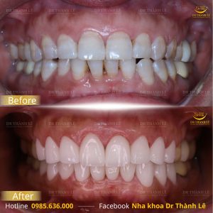 phẫu thuật cắt lợi