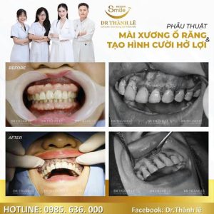 phẫu thuật cắt lợi