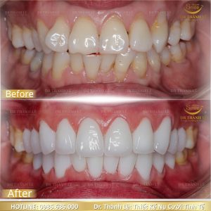 bọc răng sứ