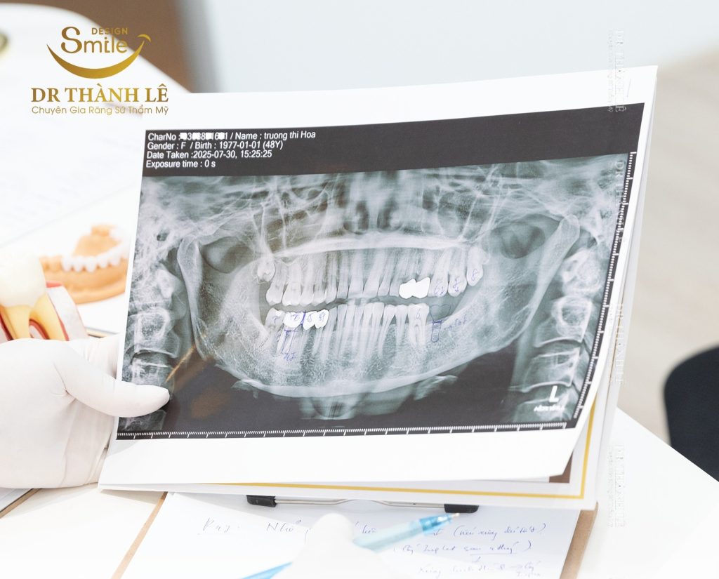 cấy răng implant