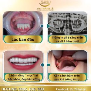 trồng răng implant